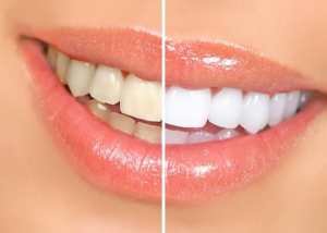 Teeth whitening results with before and after picture